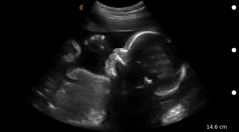 Clarius C3 - Perfil fetal en control prenatal